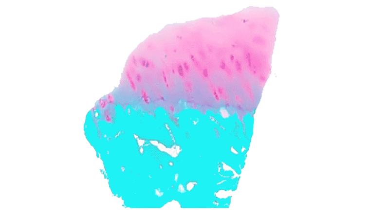 Biopsied cartilage reveals proteins present