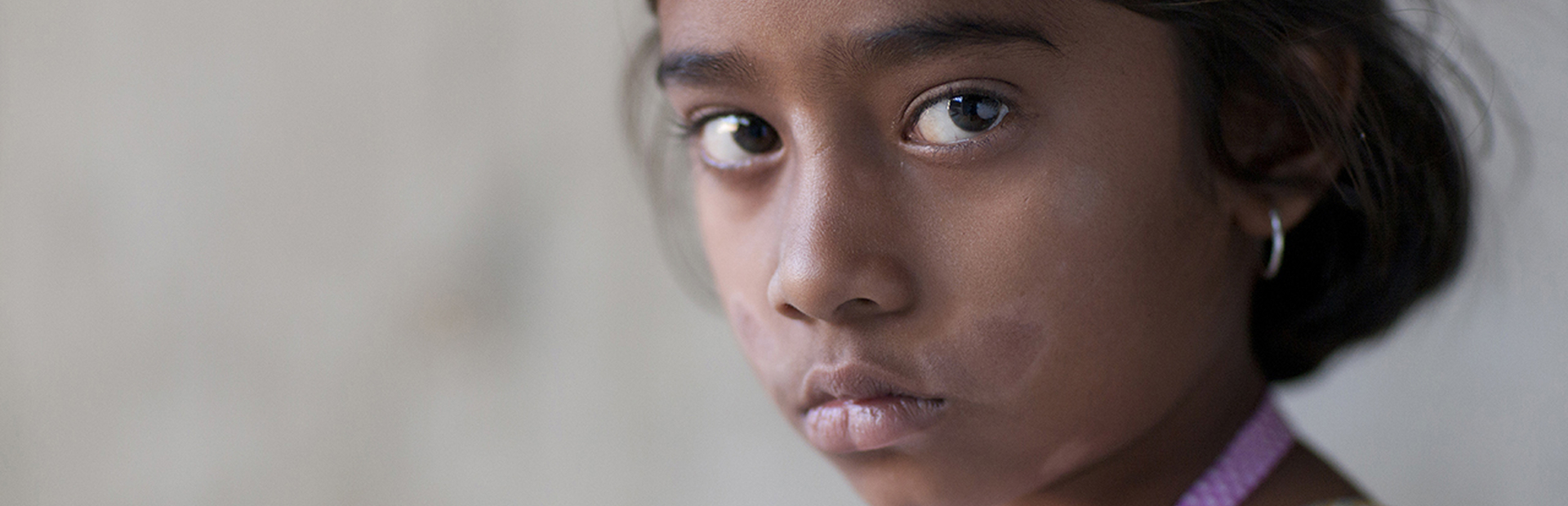 Girl with leprosy