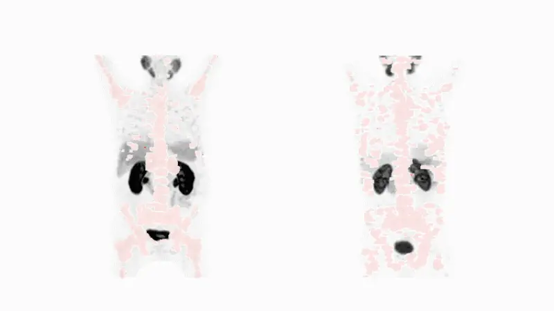 Unveiling cancer with nuclear medicine